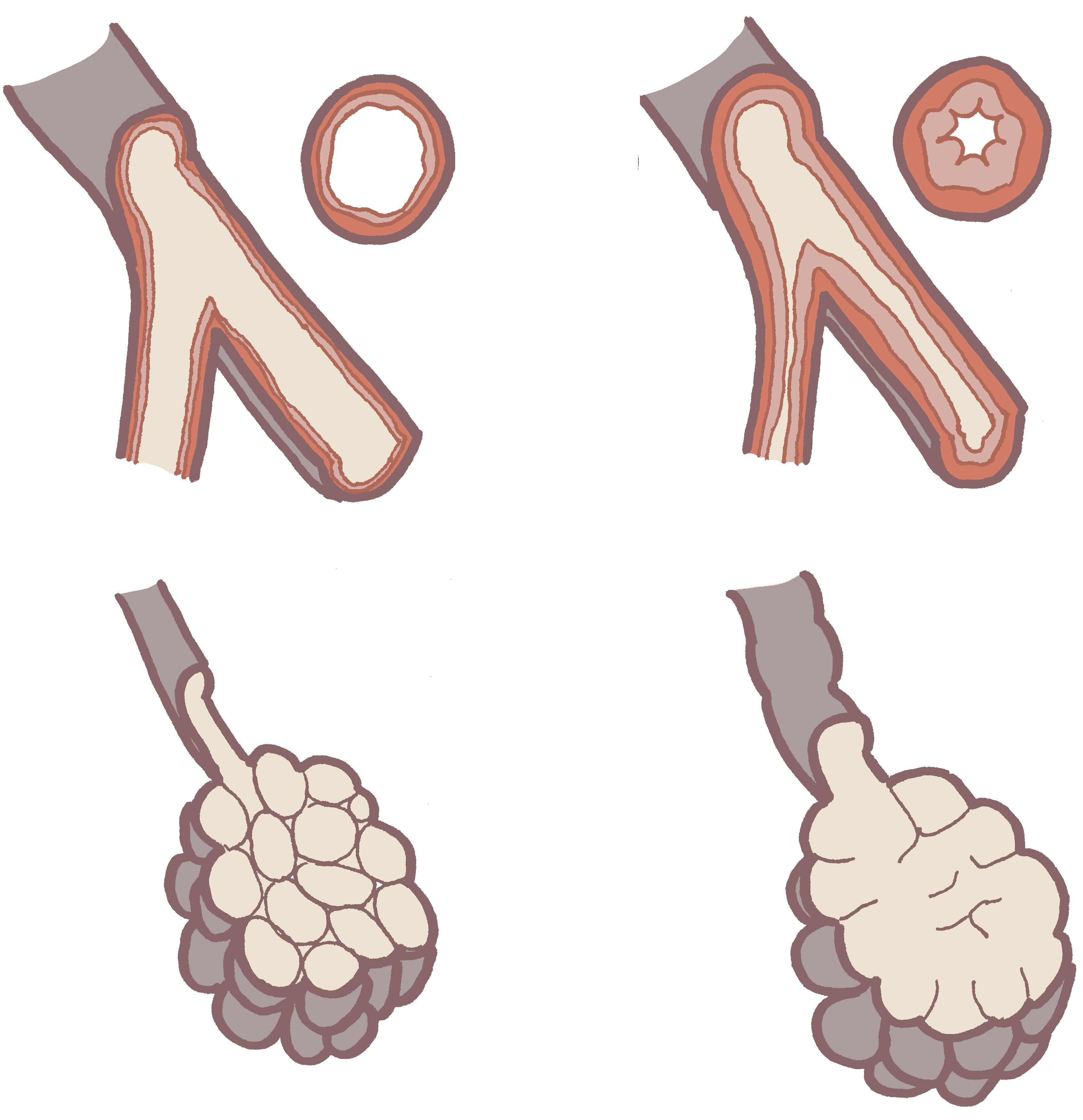 ../../_images/Alveolen-Bronchus-COPD-edited2.png