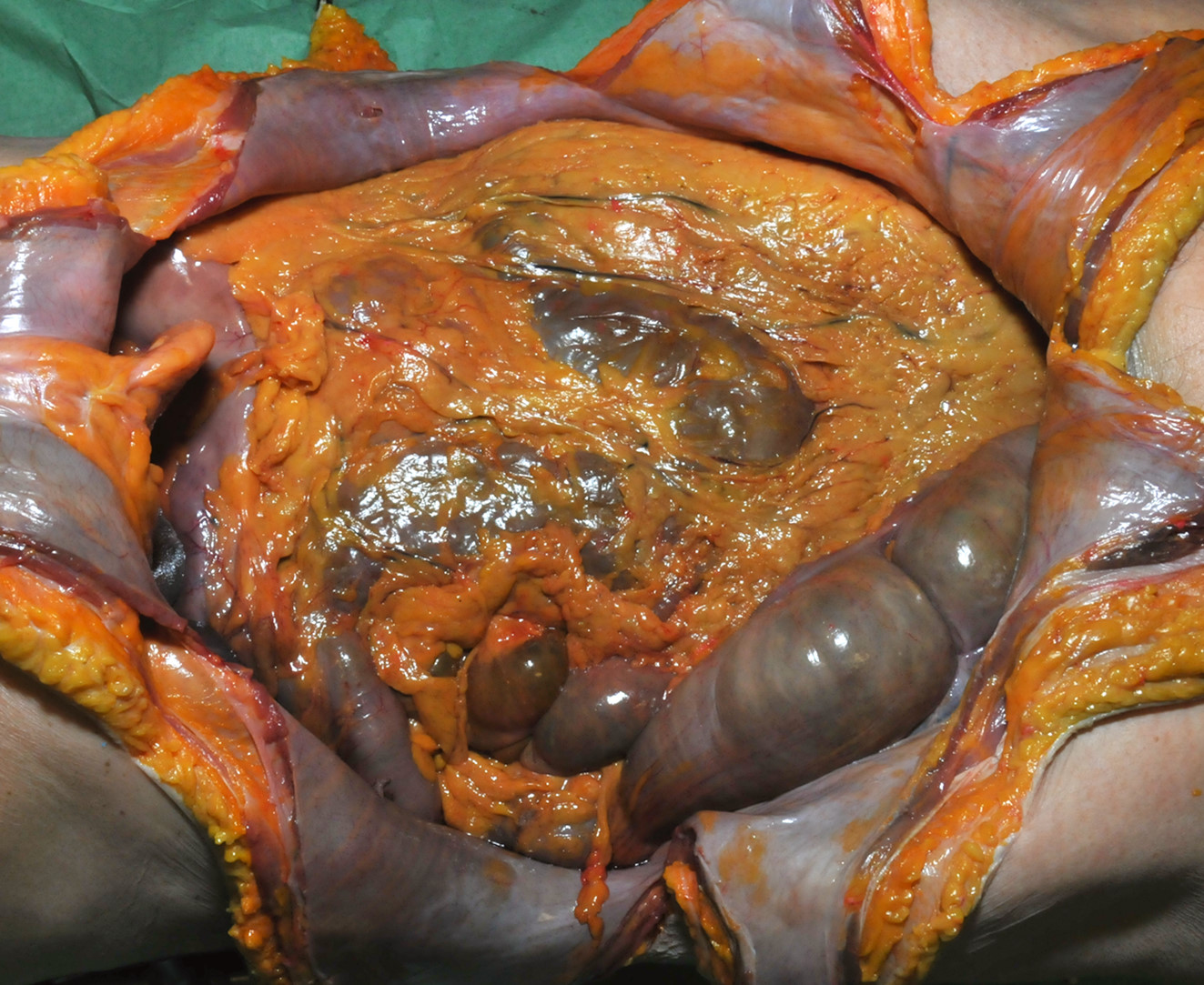Der Bauchsitus mit aufgeklappter Bauchdecke (links = kopfwärts). Am Rand sieht man deutlich den Dickdarm, unter der Fettschürze zeichnen sich die Schlingen des Dünndarms ab.