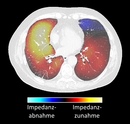 Fusions-EIT Thorax eines COPD-Patienten: Die reduzierte Ventilation im ventralen Bereich der linken Lunge (im Bild rechts oben dargestellt) ist deutlich zu erkennen © Brisanti, ℓ CC BY-SA 4.0