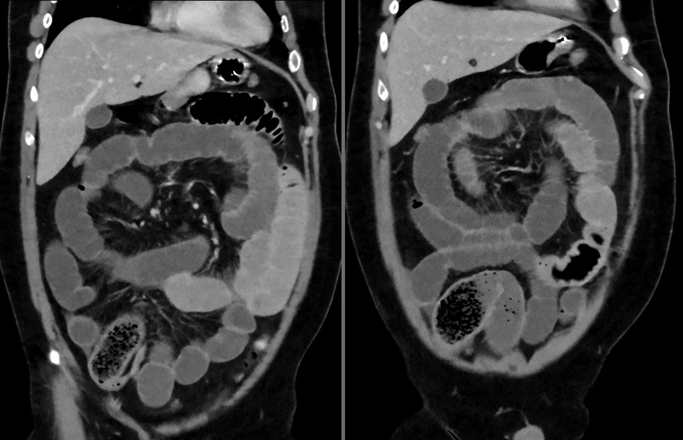 Dünndarmileus bei einem jungen Mann nach offenbar übermäßigem Essen von Chia-Samen. Computertomographie 2 Schichten koronar. Man erkennt den akkumulierten Bolus im unteren Dünndarm, den nachfolgenden Hungerdarm und die dilatierten, vorgeschalteten Schlingen