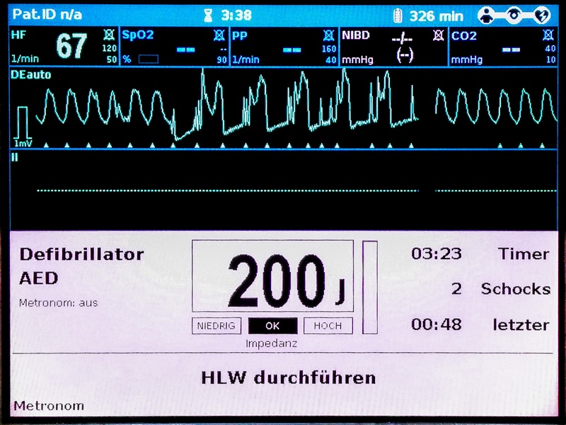 Monitor-Bild während einer Reanimation im AED-Modus: Ventrikuläre Tachykardie und Bewegungsartefakte durch die Herzdruckmassage.