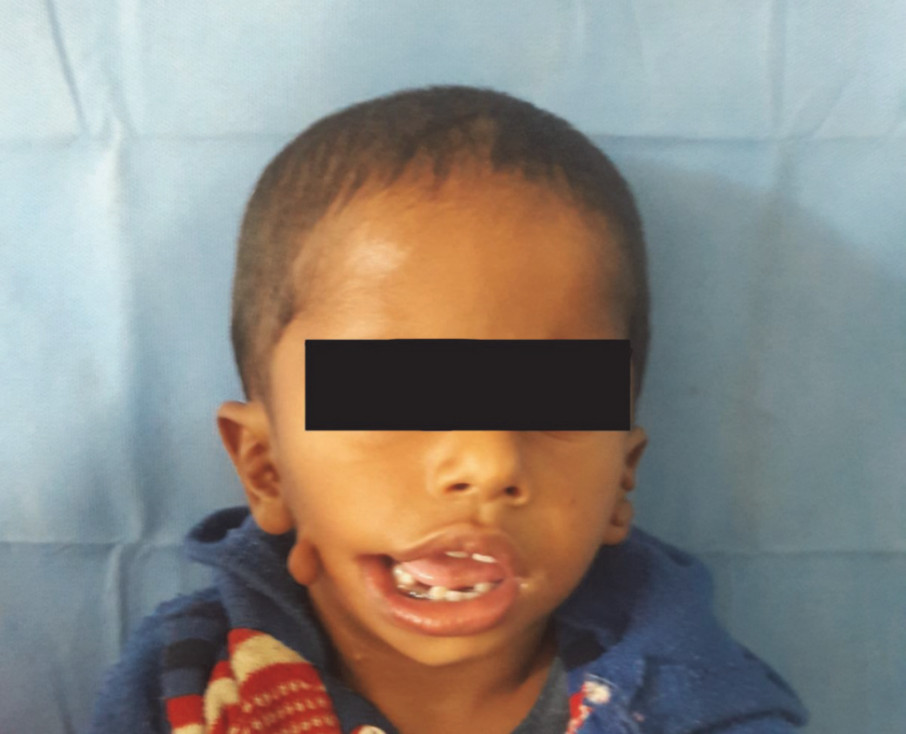 Fehlbildung (Goldenhar Syndrom) ©  Bedi, Mitesh; Jain, Rakesh Kumar; Barala, Vipin Kumar; Singh, Abhimanyu; Jha, Hiranmayi, ℓ CC BY 4.0