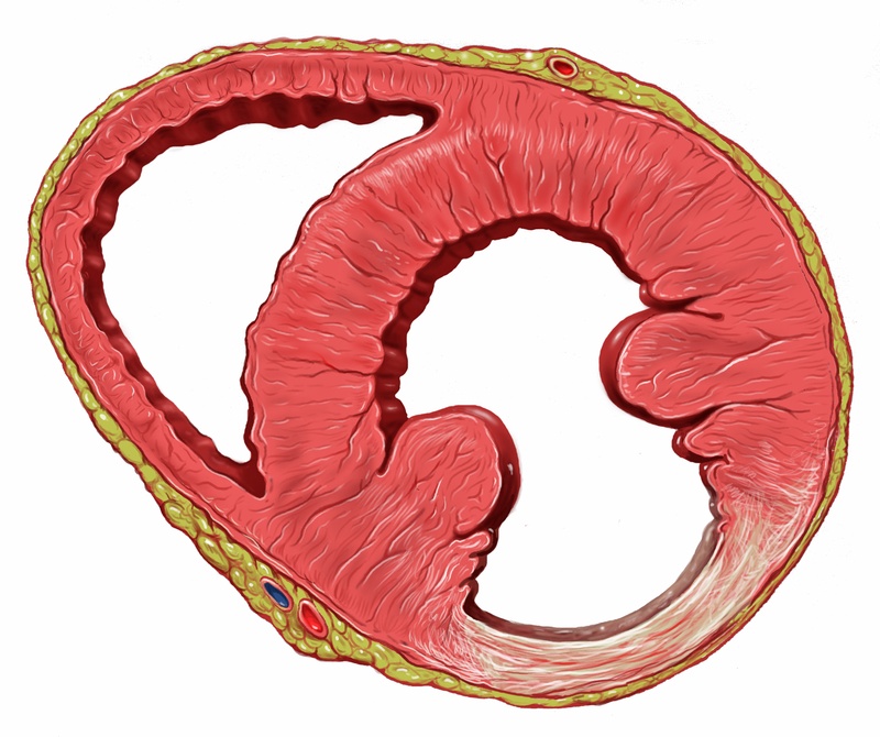 stirbt nach einiger Zeit ab, es bildet sich eine (funktionslose) Narbe, die Herzleistung ist in Folge beeinträchtigt. © Patrick J. Lynch, medical illustrator, C. Carl Jaffe MD, cardiologist