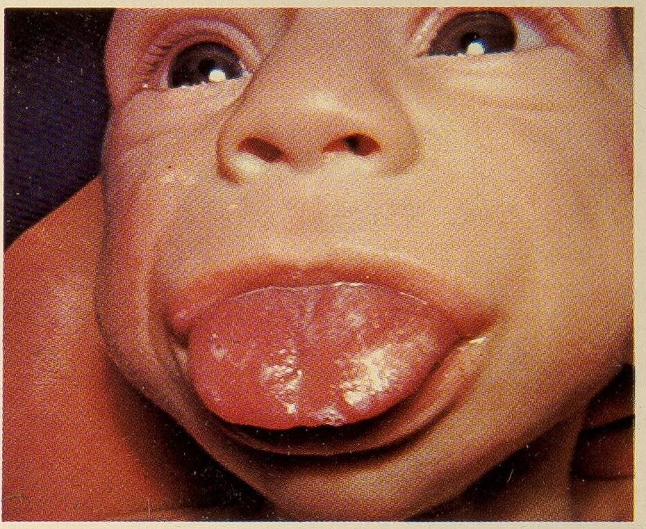 Makroglossie © US Government, ℓ PD