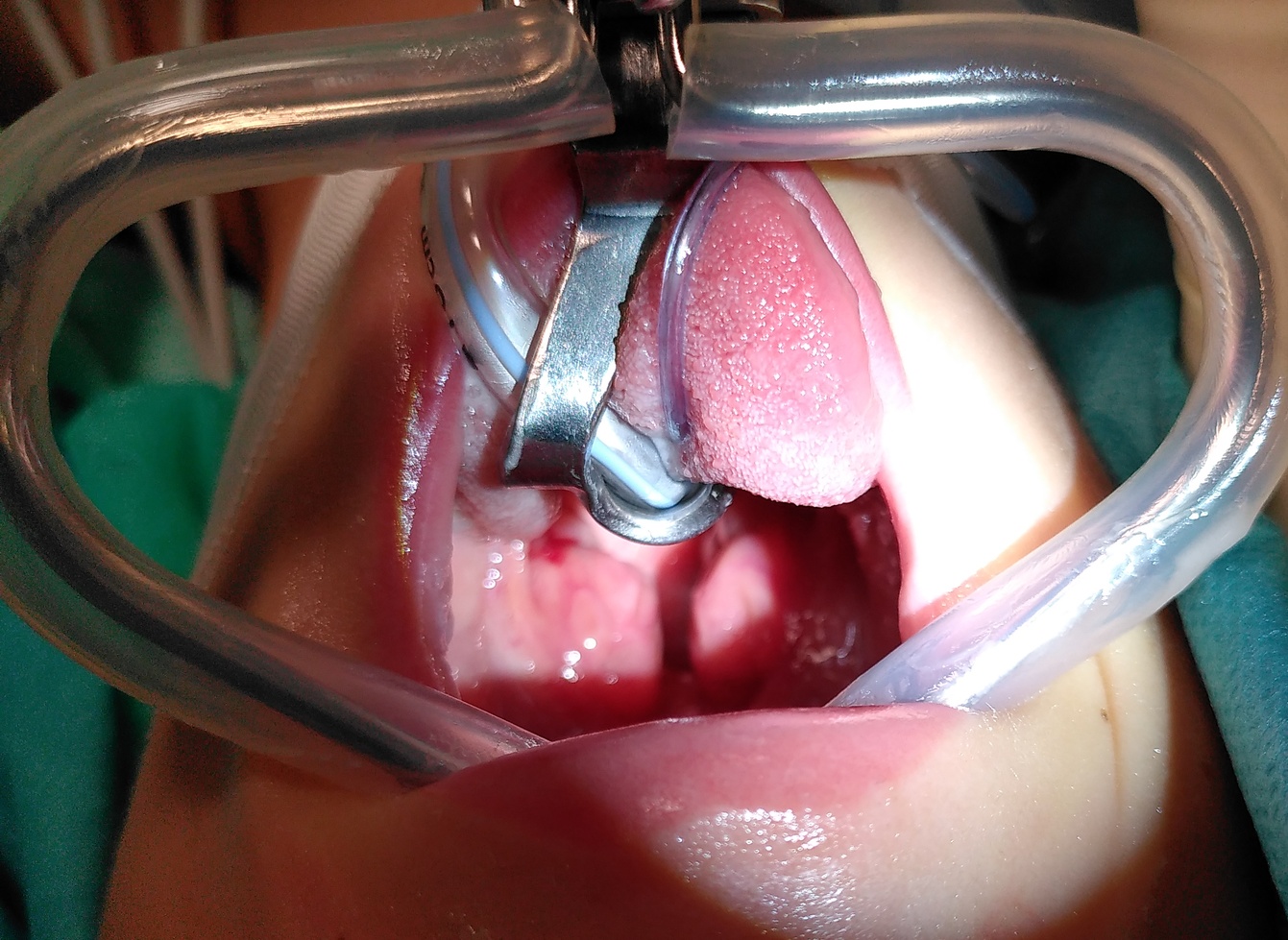 Tonsillenhypertrophie