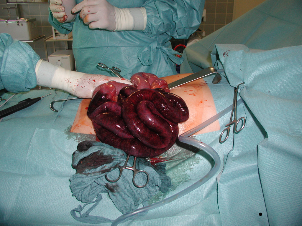 Bridenileus des Dünndarms durch Verwachsungen mit Gangrän eines Teils des Jejunums: OP-Situs