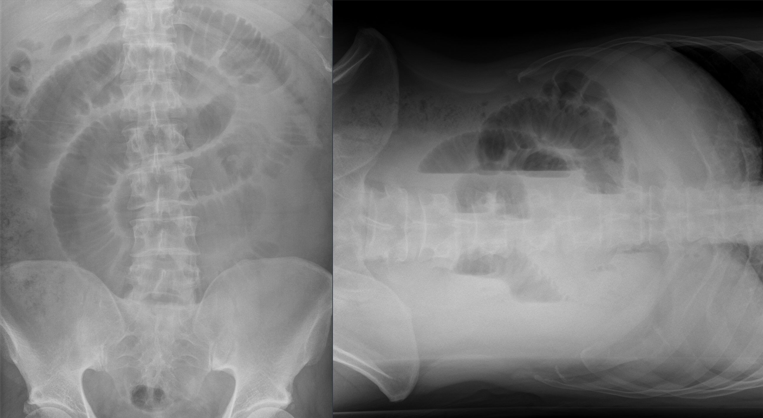 Mechanischer Dünndarmileus im Röntgenbild in 2 Ebenen.