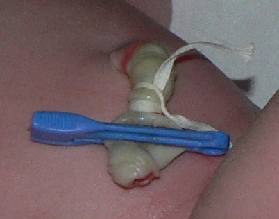 Abgeklemmte Nabelschnur © WMC: "Harmid" ℓ PD