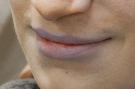 Zyanotische Lippen können schon frühzeitig auffallen.