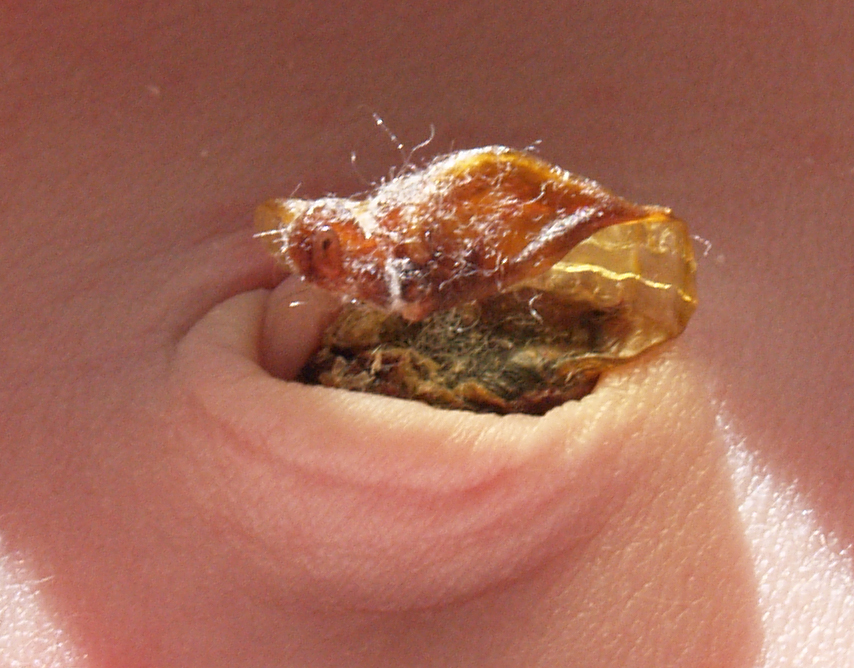 Nabelschnurstumpf nach sieben Tagen © WMC: "Fatrabbit" ℓ PD