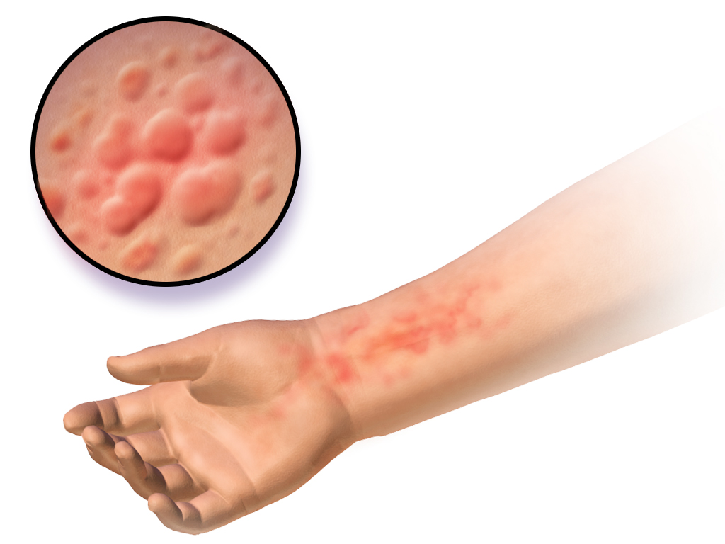 ../../_images/Urticaria.png