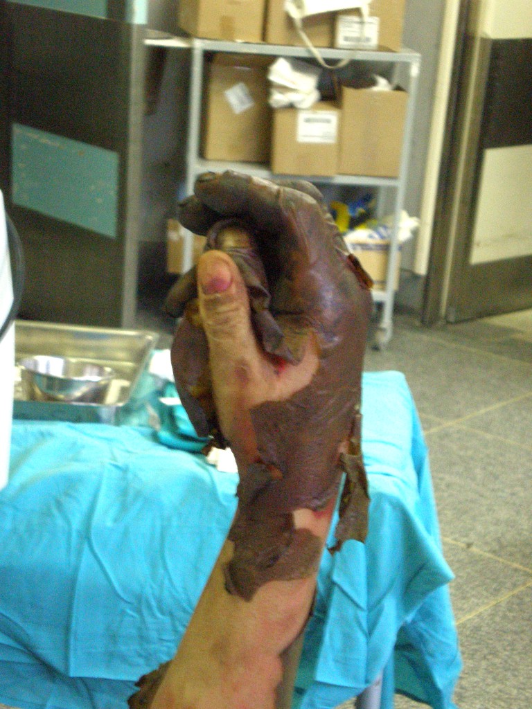 Ablederung nach schwerer Verbrennung