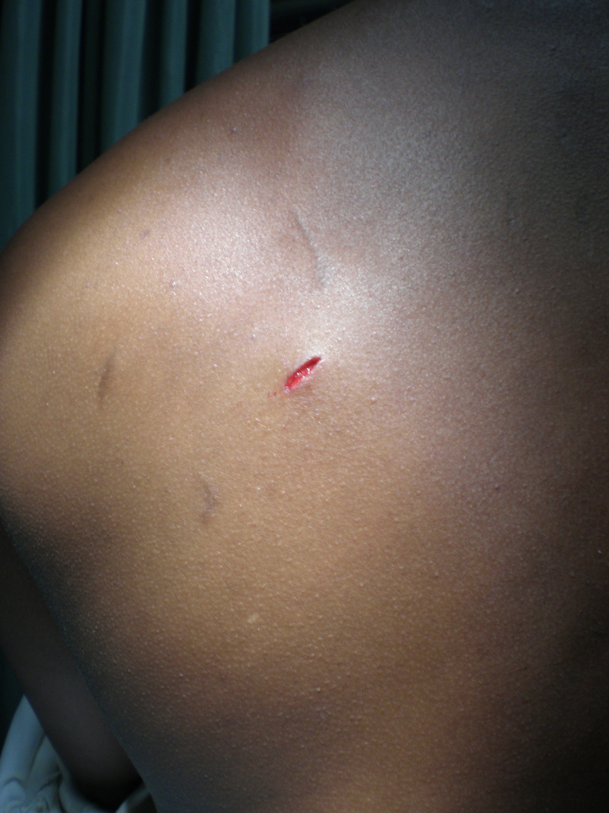 Stichverletzung: unauffällig. Dieser Patient ist lebensgefährlich verletzt! (Pneumothorax)