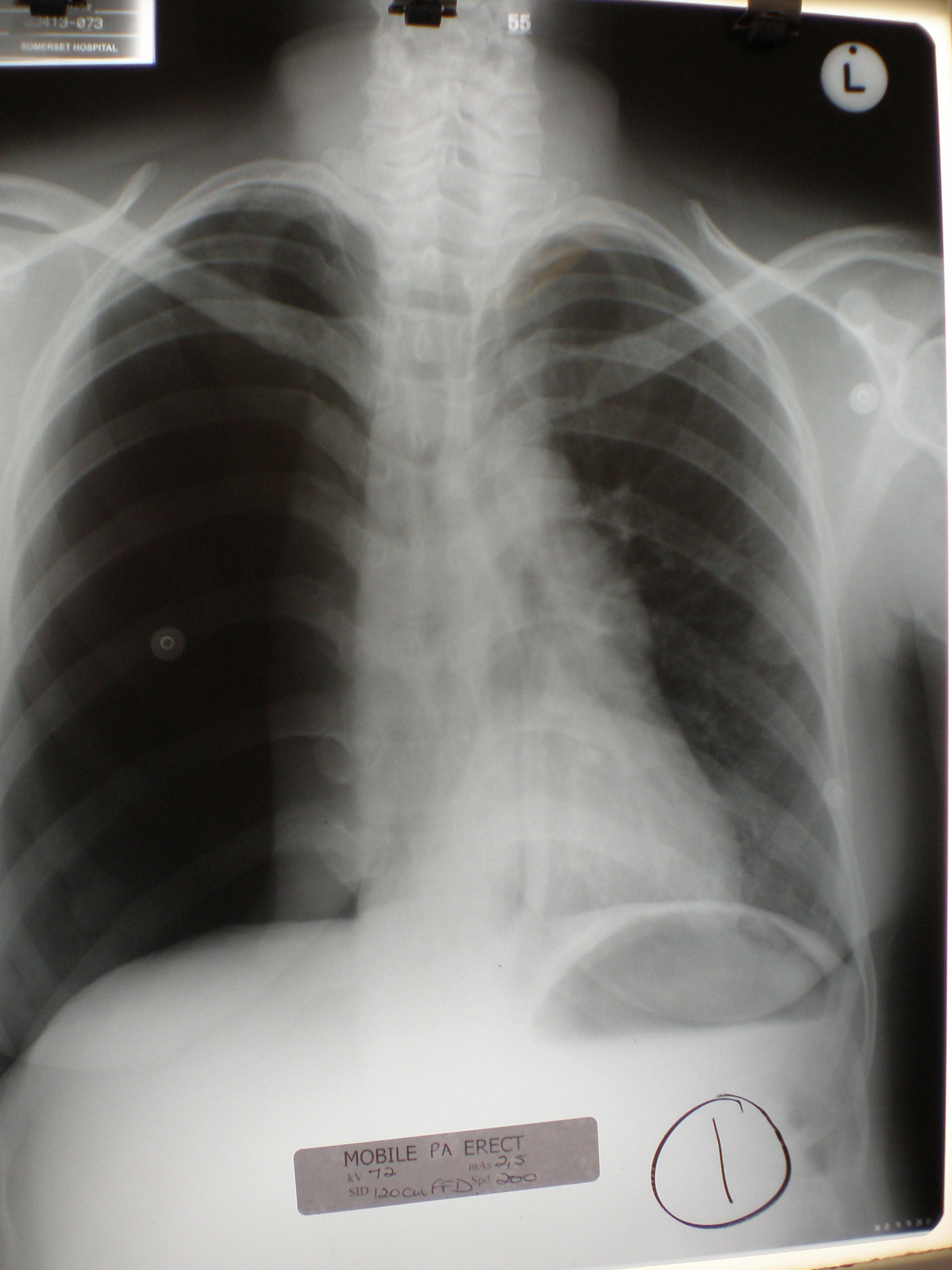Im Vergleich: Kompletter Pneumothorax der rechten Seite (auf dem Bild auf der linken Seite). Die Lunge ist kollabiert.
