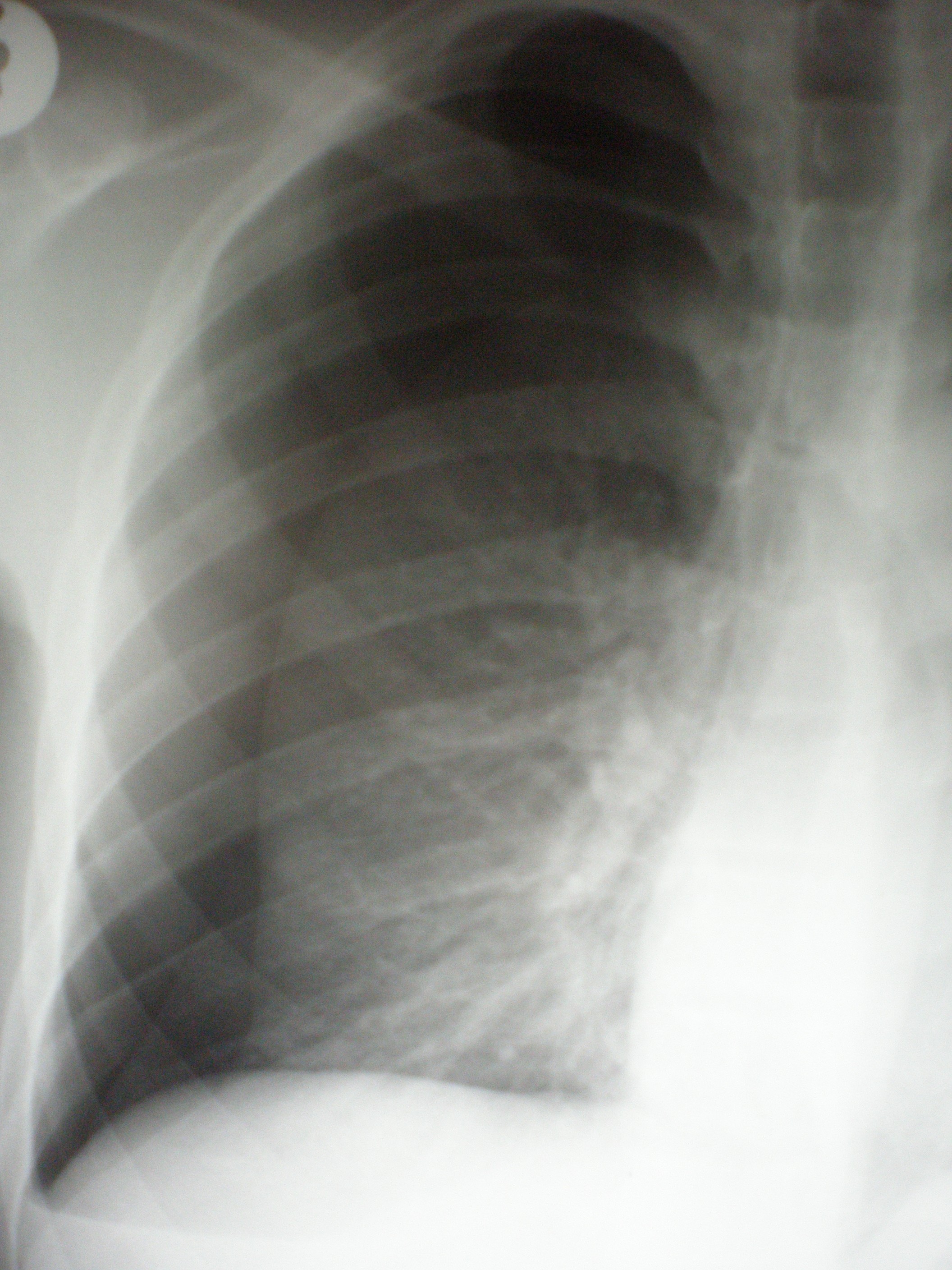 Pneumothorax. Beachte die Randlinie zwischen Lunge (unten, innen) und dem luftgefüllten Pleuraspalt (oben, außen)