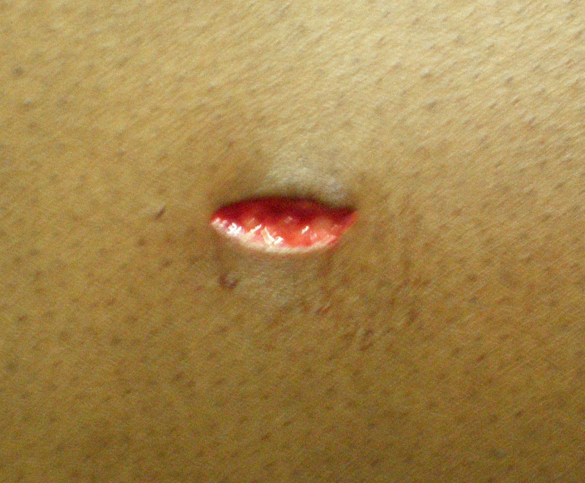 Glatte Wundränder und eigentlich ganz unauffällig: Die Stichwunde.