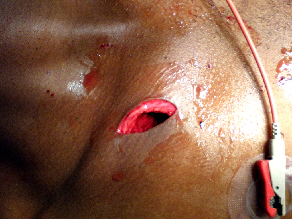 Stichwunde mit eröffneter Brusthöhle.