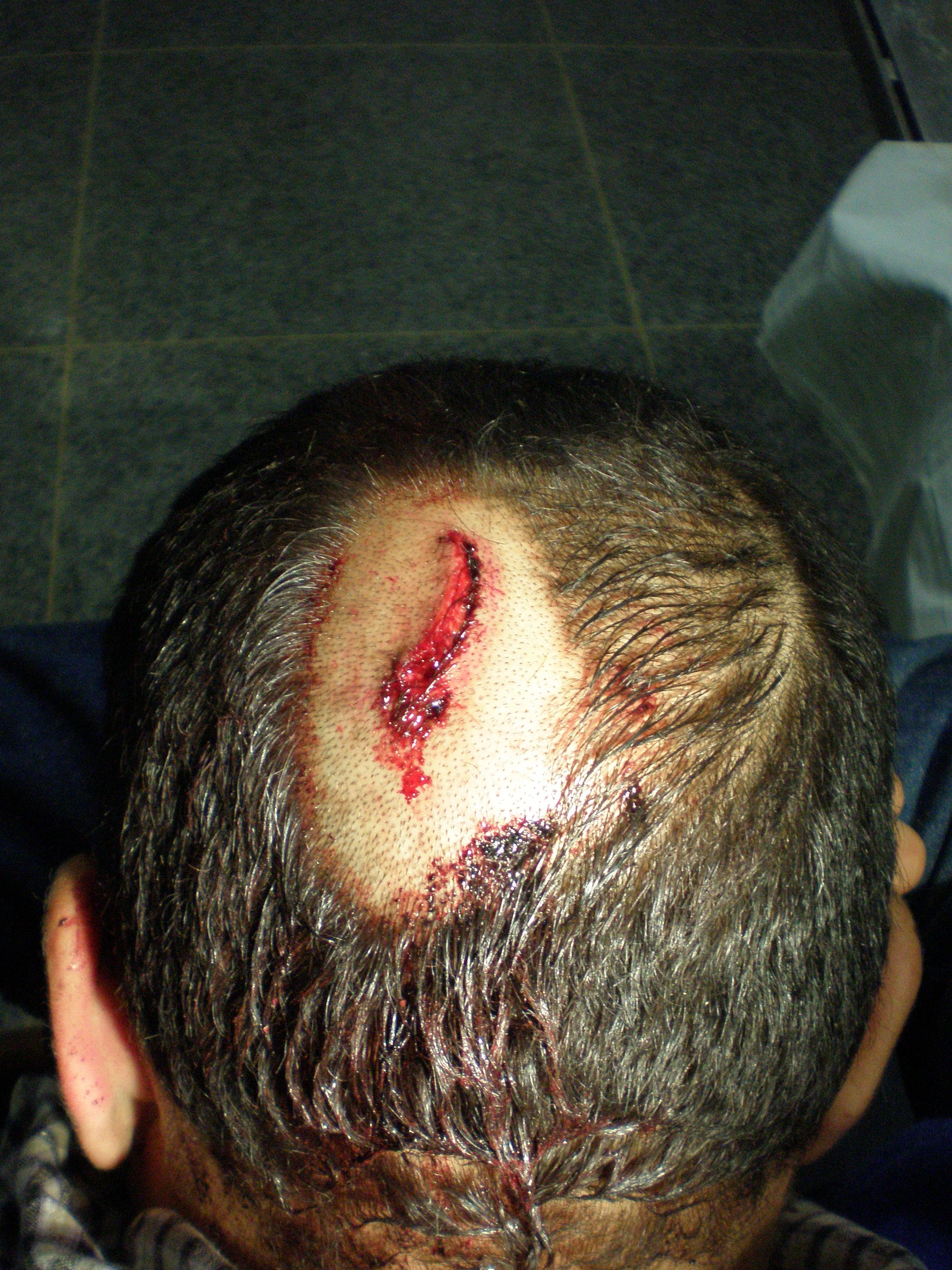 Rissquetschwunde vor der Versorgung im Spital