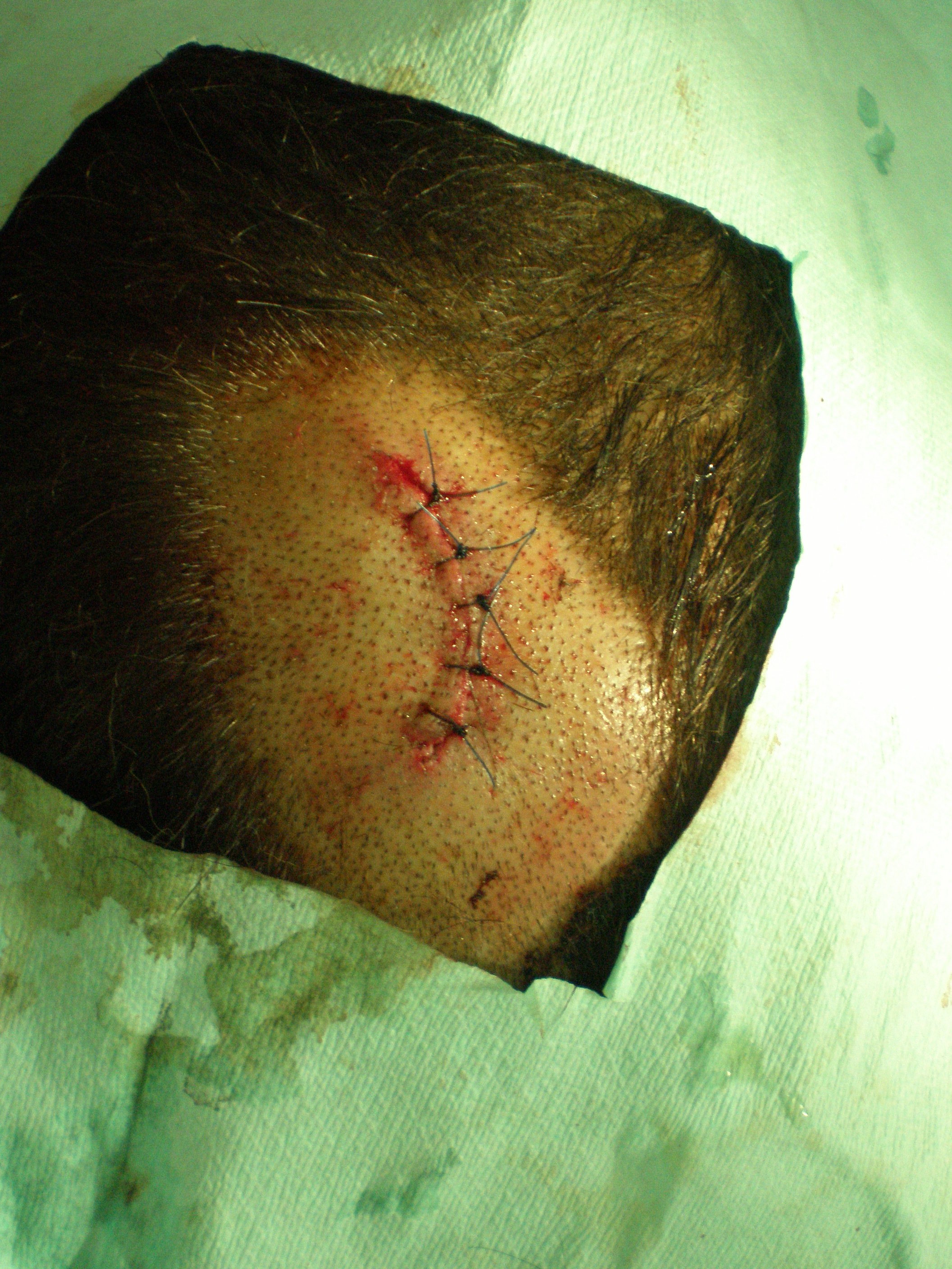 Rissquetschwunde nach der Versorgung im Spital